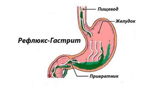 Бульбит Желудка Симптомы Причины Лечение Диета