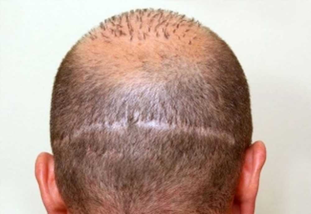 Операция на головном мозге сбривают ли все волосы