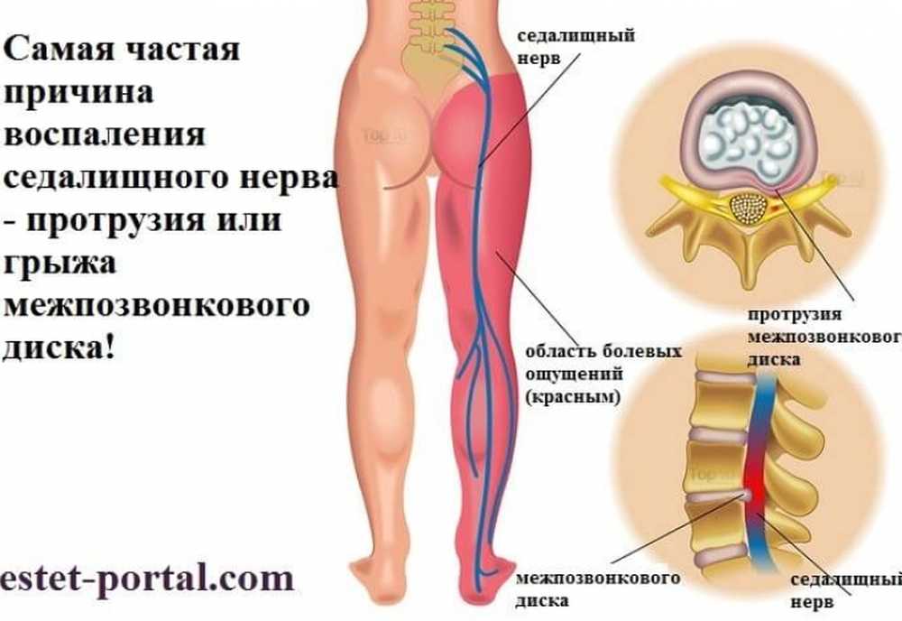 Сильные боли седалищного нерва