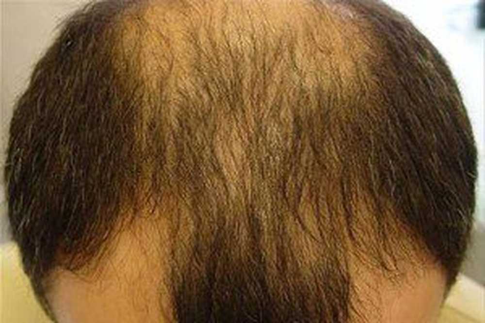 Волосы выпадают короткими. Очаговая (гнездная) алопеция. Андрогенетическая алопеция у мужчин.