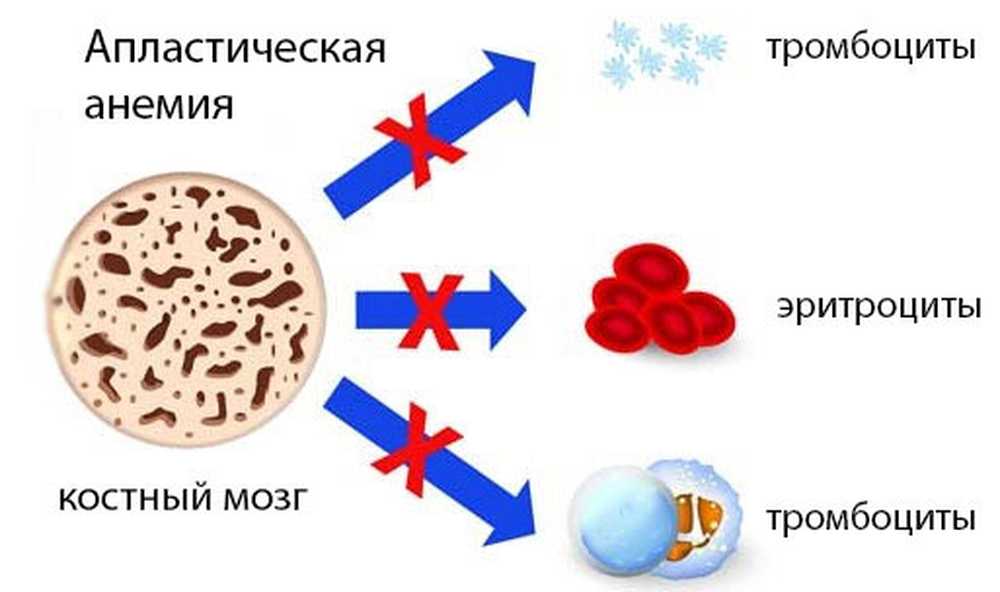 Морфологическая картина гипоплазии костного мозга