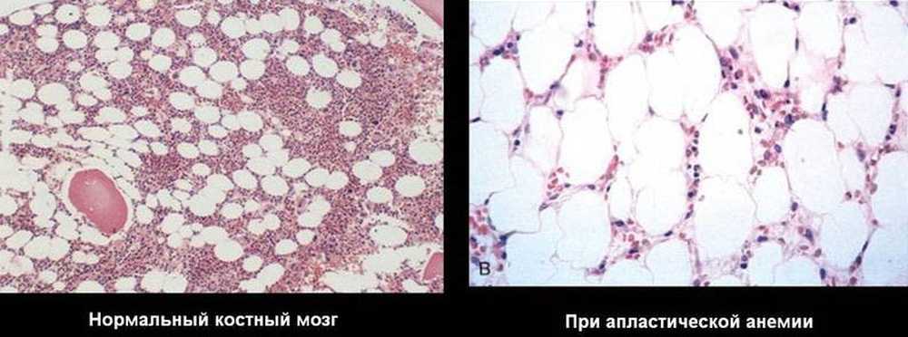 костная трабекула в красном мозге. анемия костный мозг гистология. нормальная клеточность костного мозга. жировые клетки в костном мозге.