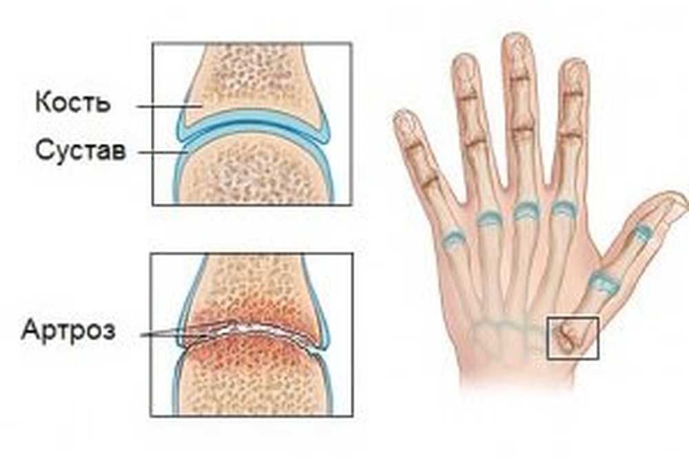Можно хрустеть руками. Артроз суставов кистей причины. Полиостеоартроз суставов кистей 1 степени. Ревматоидный артрит пястно фаланговый. Деформирующий полиостеоартроз 2 степени кистей рук.