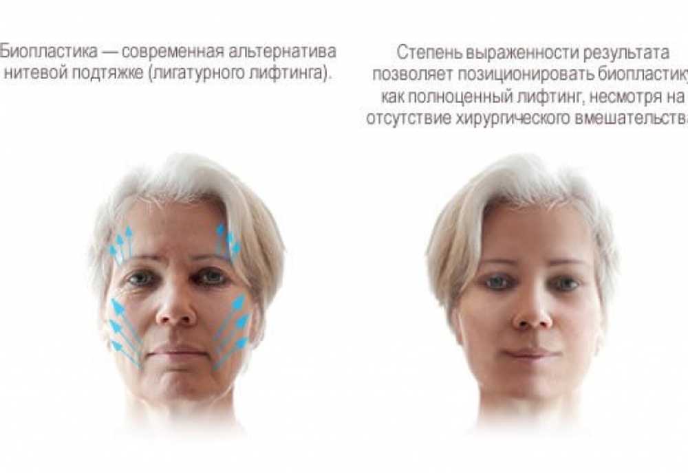 Препарат Для Лица Биопластика Купить