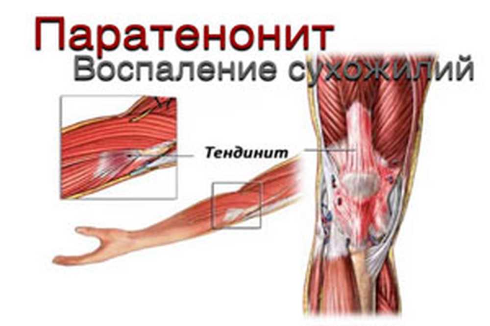 Тендинит сухожилия пальца