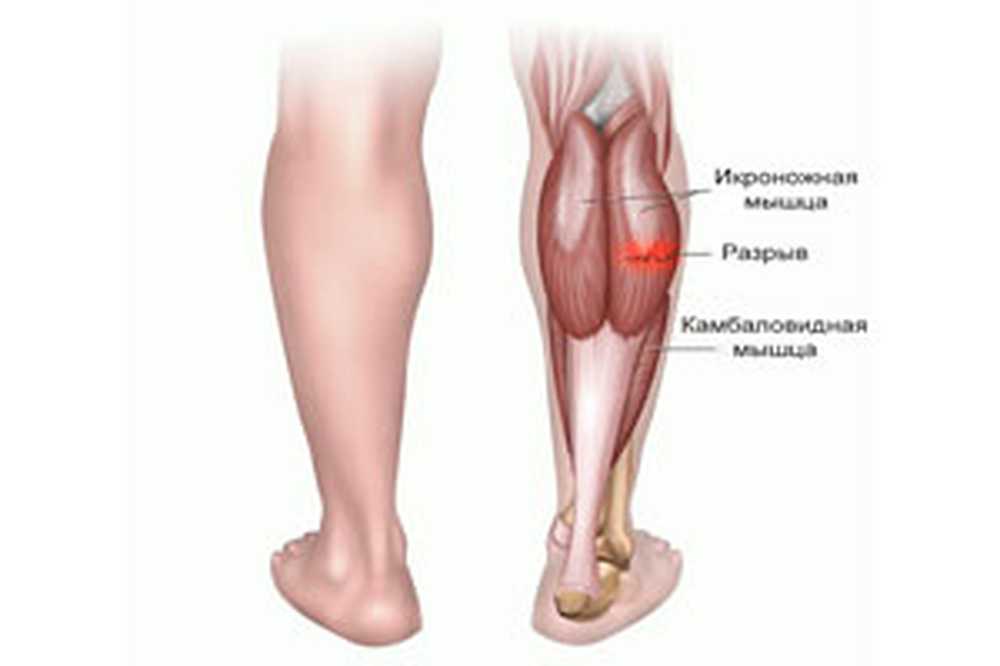 Сильные боли ноги ниже колена причины. Голень ноги. Икры ног.