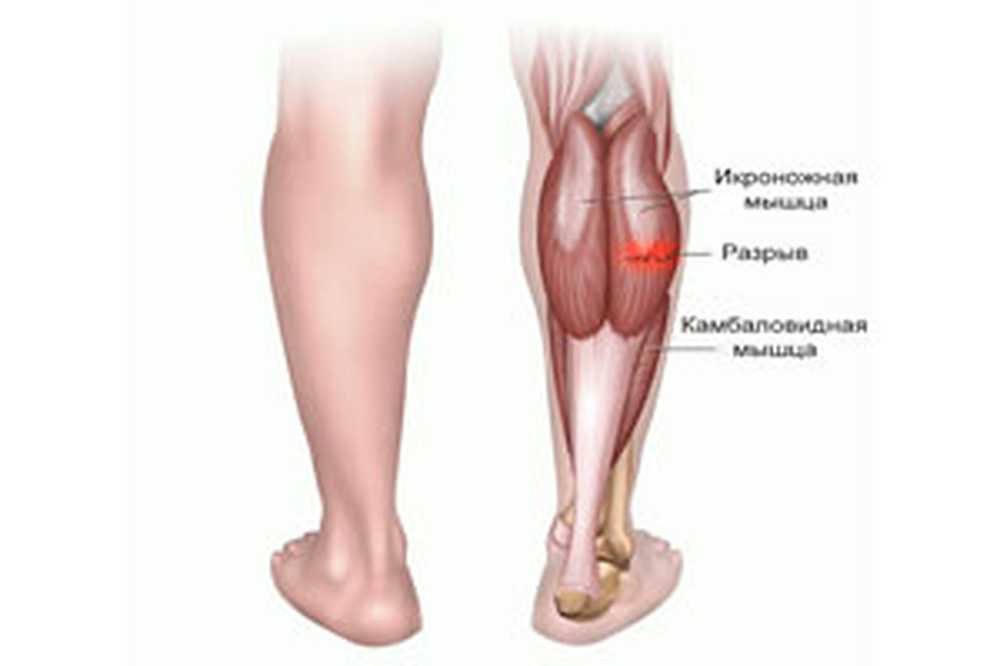 Боль в икрах ног у мужчин. Голень ноги. Икры ног.