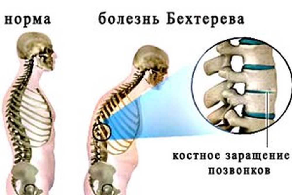 Болезнь бехтерева что это такое. Физкультура при болезни Бехтерева. Болезнь Бехтерева (воспаление позвоночника). Болезнь Бехтерева поясничного отдела симптомы. Болезнь Бехтерева упражнения.