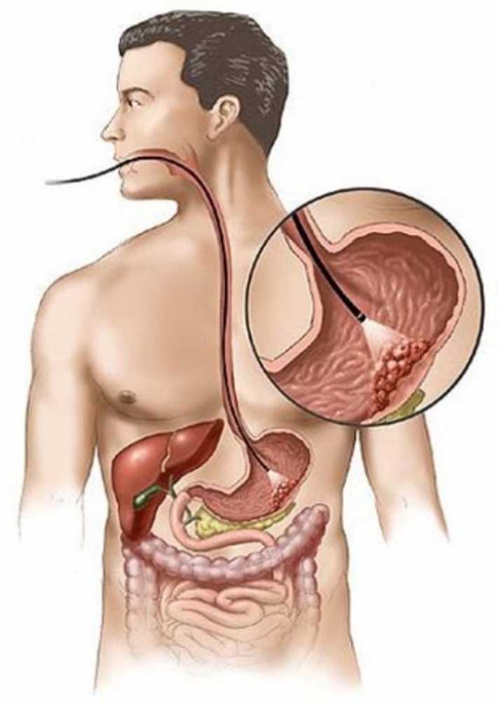 Желудок попадает в легкое. Язва 12 перстной кишки ФГДС. Двенадцатиперстная кишка ФГДС. Гастроскопия желудка гастрит. Гастроскопия двенадцатиперстной кишки.