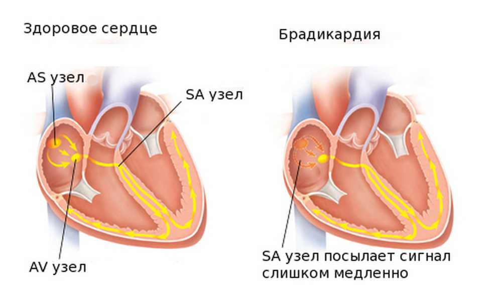 Что такое брадикардия сердца. Брадикардия порок сердца. Брадикардия сердца что это. Бадигади. Бродик.