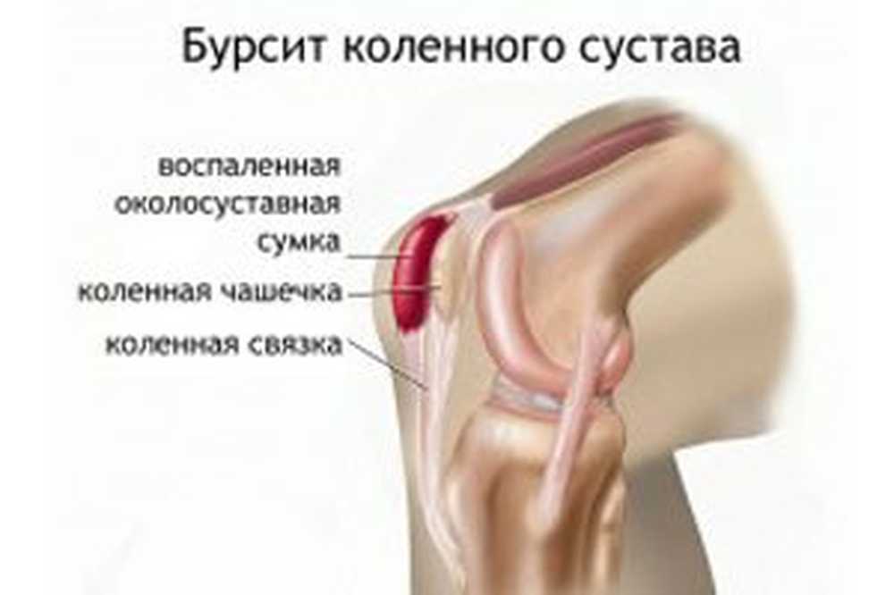 Что Такое Бурсит Фото