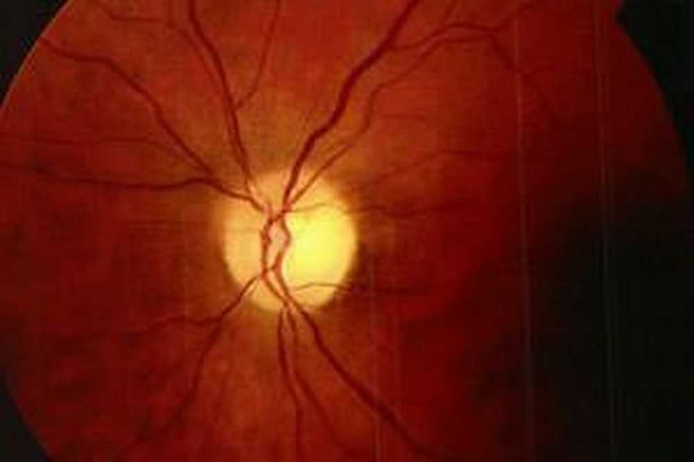 Расширение пространства зрительного нерва. Частичная атрофия зрительного нерва. Частичная атрофия зрительного нерва глазное дно. Атрофия зрительного нерва Лебера. Атрофия зрительного нерва мкб.