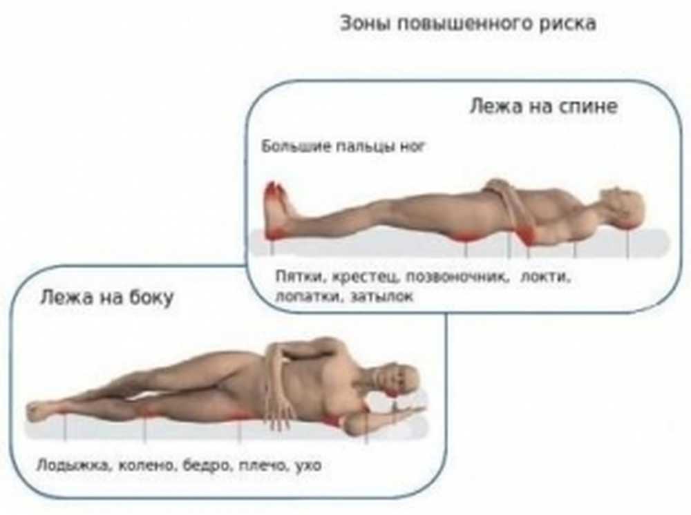 Лежачая как поставить на ноги. Зоны повышенного риска образования пролежней. Пролежни у лежачих больных. Места образования пролежней лежа на боку.