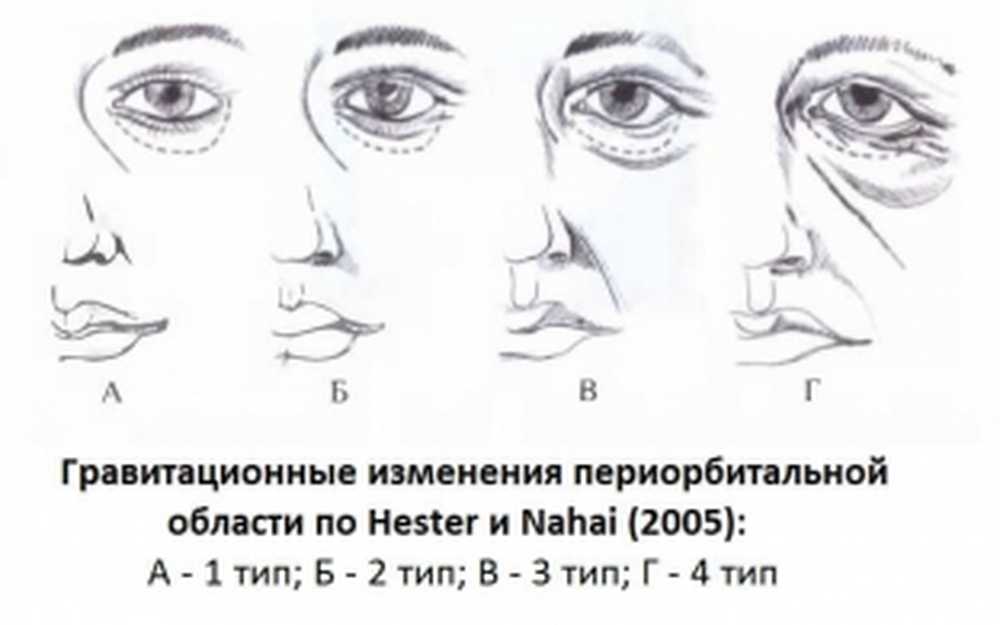 Параорбитальная. Старение лица: периорбитальная область анатомия. Классификация возрастных изменений периорбитальной области. Возрастные изменения периорбитальной зоны. Возрастные изменения лица анатомия.