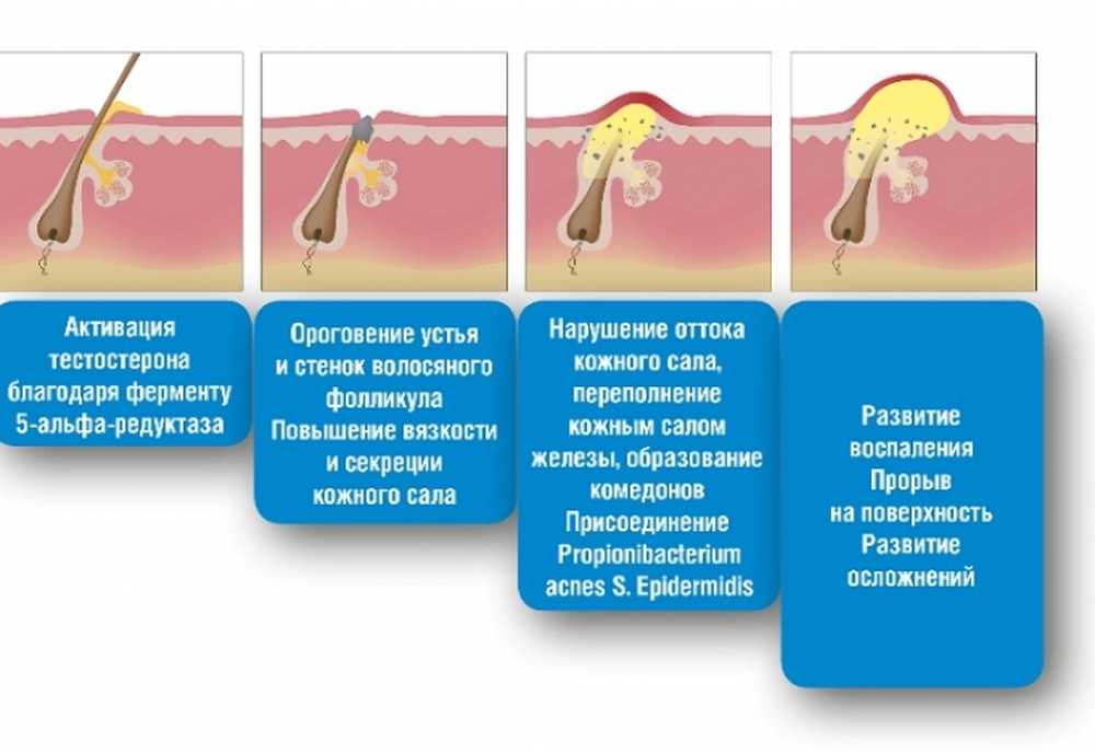 Почему появляются воспаления. Этапы формирования акне.