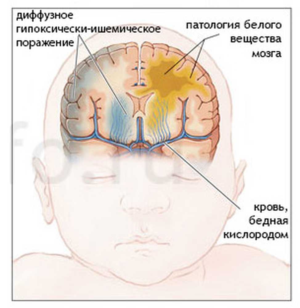 Ишемически гипоксическое поражение головного