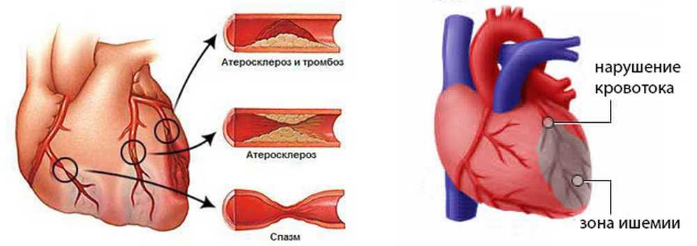 Легкая ишемия. Ишемия нарушение кровоснабжения. Ишемическая болезнь сердца схема. Нарушение кровоснабжения миокарда. Спазм коронарных сосудов сердца.