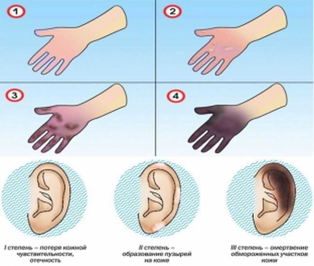 Степени отечности. Обморожение 1 степени первая. Отморожение 3 степени симптомы.