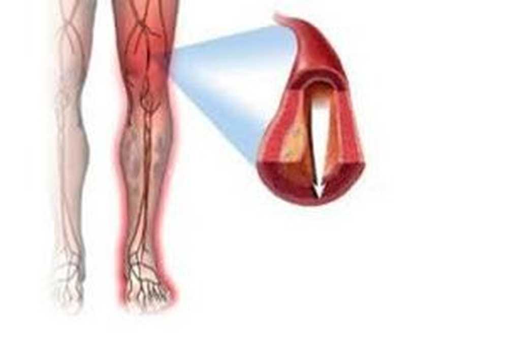 Атеросклеротическое поражение нижних конечностей. Облитерирующий атеросклероз ног. Облитерирующий атеросклероз сосудов нижних конечностей. Облитерирующие заболевания сосудов конечностей. Облитерирующие заболевания сосудов нижних конечностей.