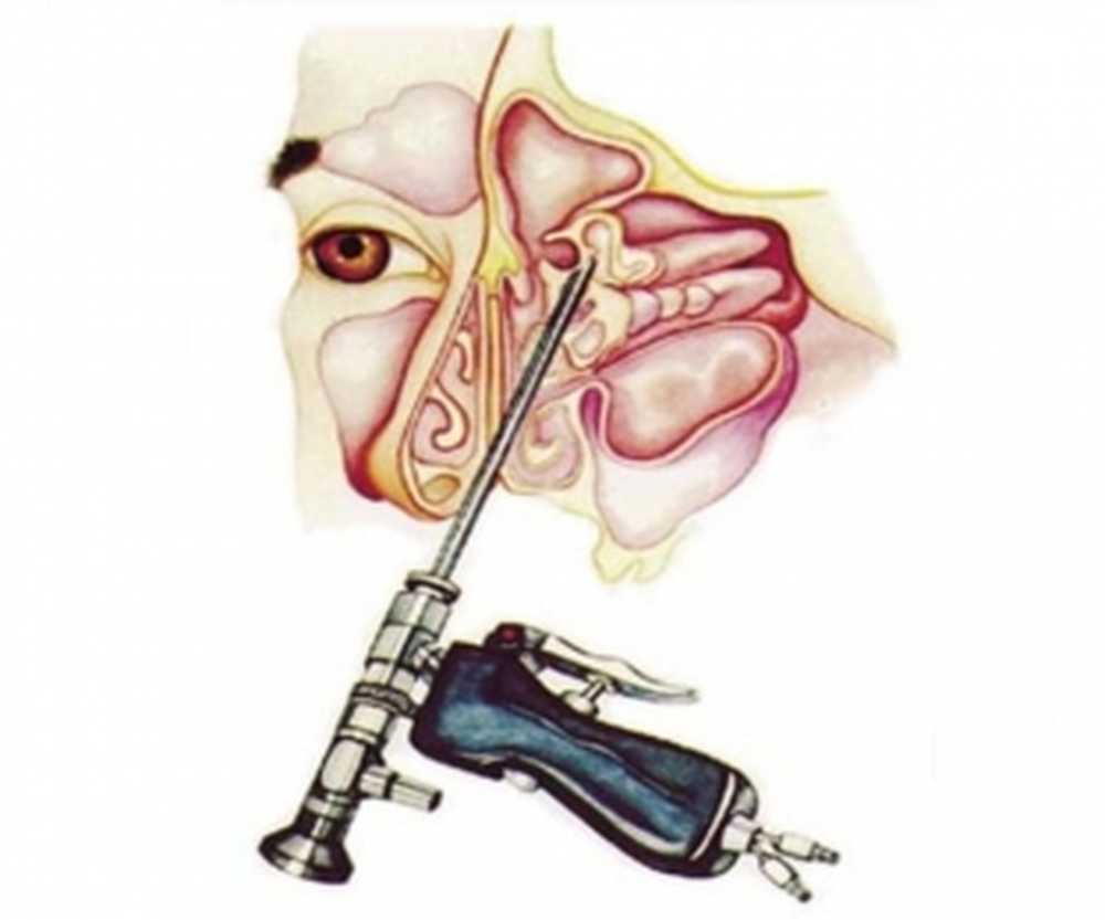 Гайморит сделали прокол
