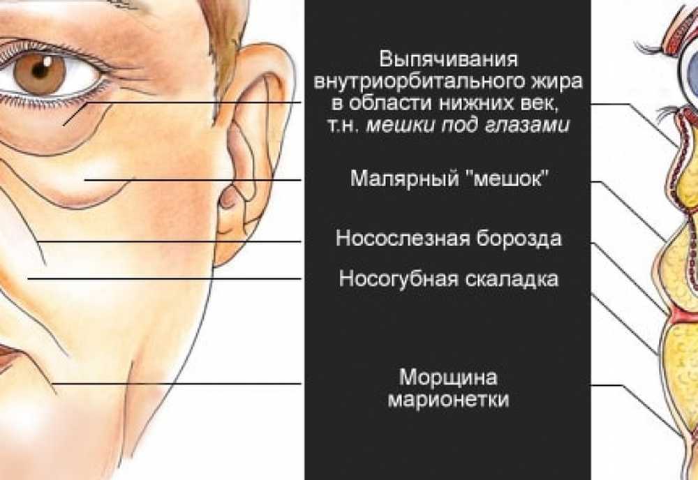 Припухлости на скулах под глазами. Малярные мешки. Малярные мешки под глазами. Мешки на скулах под глазами. Малярный жировой мешок.