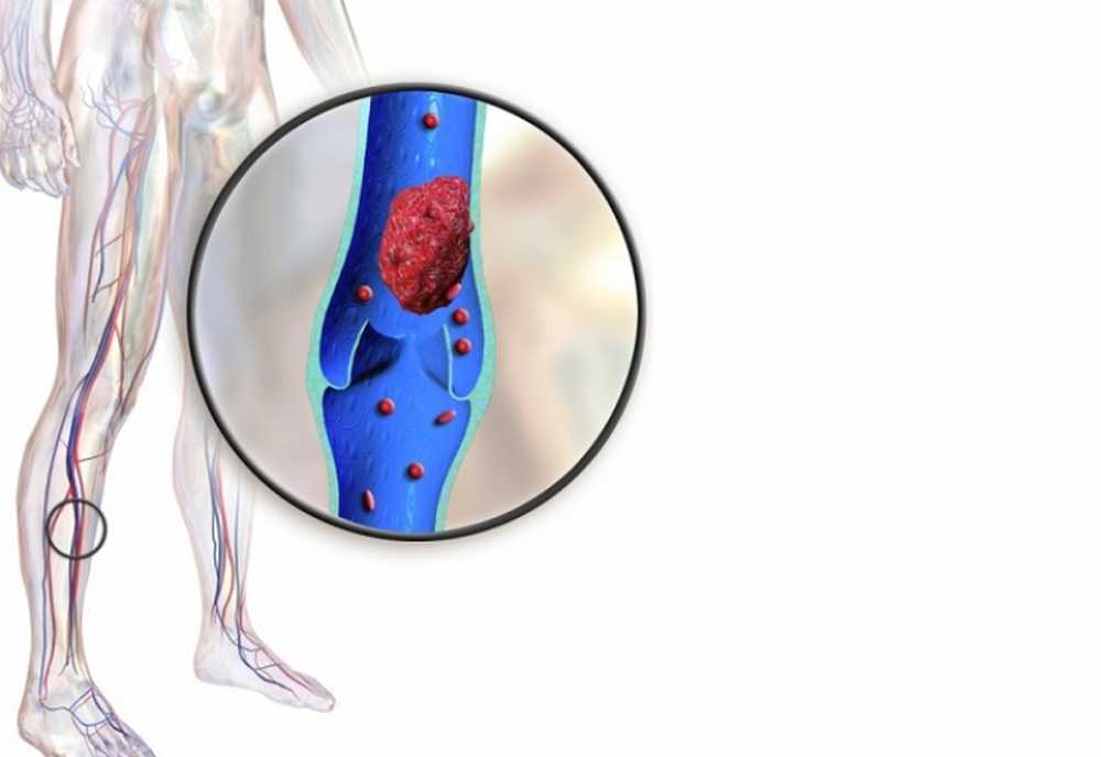 Став тромбы. Тромбофлебит вен нижних конечностей. Флеботромбоз голени клиника.