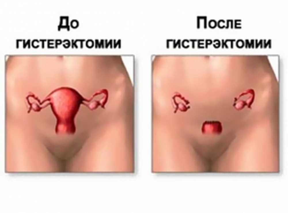 Фото Операция Женский Половой Орган