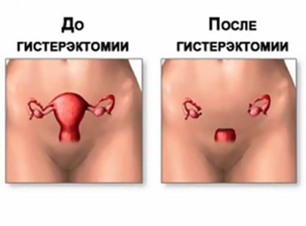 Удаление матки и половая жизнь