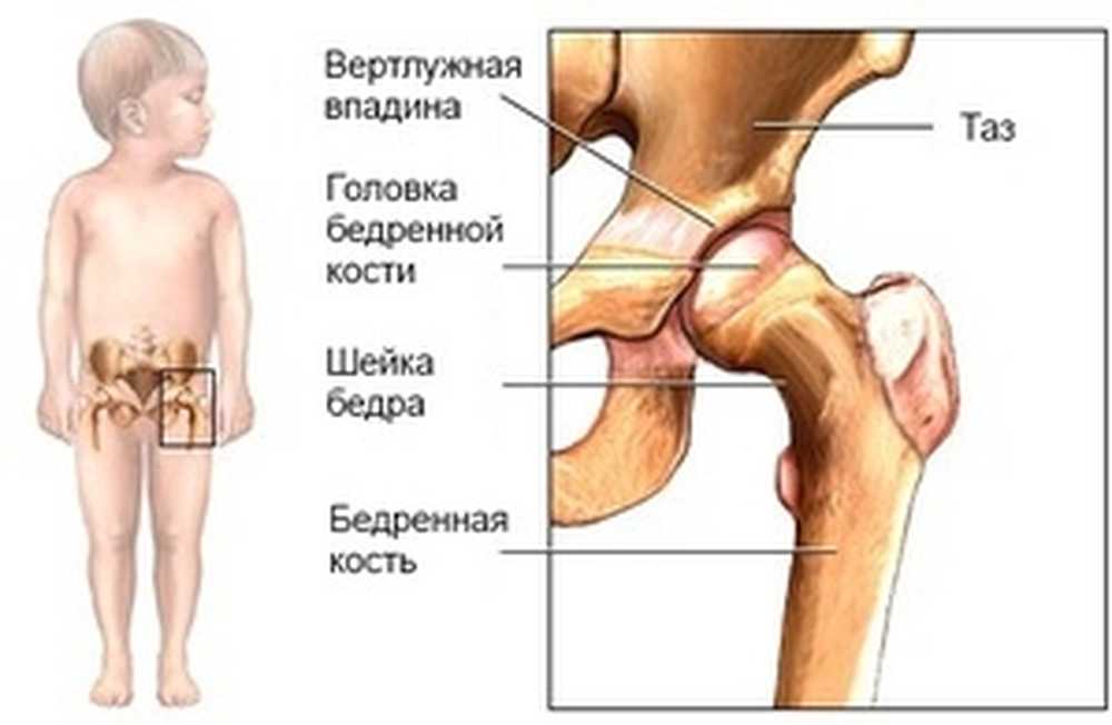 Тазобедренный артрит у ребенка