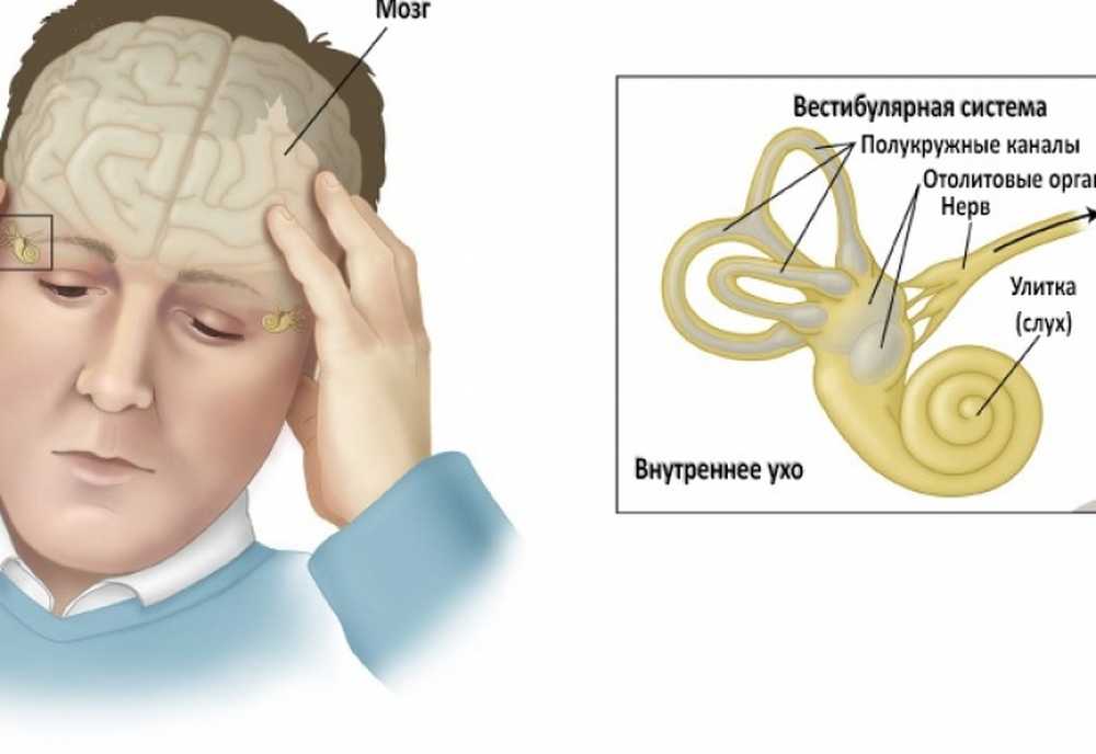 Вестибулярные нарушения причины. Заболевания вестибулярного аппарата. Вестибулярные нарушения. Нарушение вестибулярного аппарата симптомы. Нарушение вестибулярного аппа.
