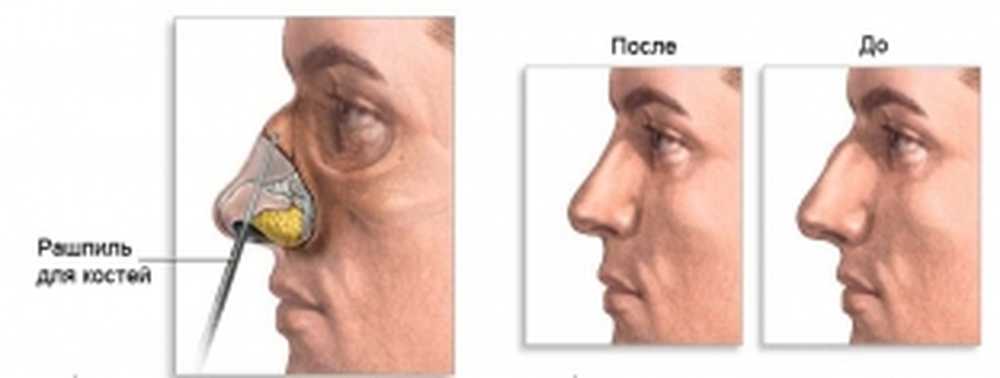 Можно вправить нос. Вправление перелома костей носа. Закрытая репозиция костей носа. Перелом костей спинки носа.