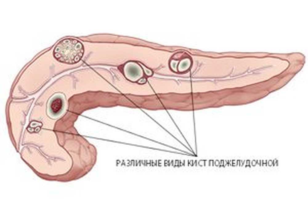 Панкреатит головка. Кисты поджелудочной железы классификация. Доброкачественные эпителиальные опухоли поджелудочной железы. Кисты поджелудочной железы кт классификация. Кистозные образования поджелудочной железы.