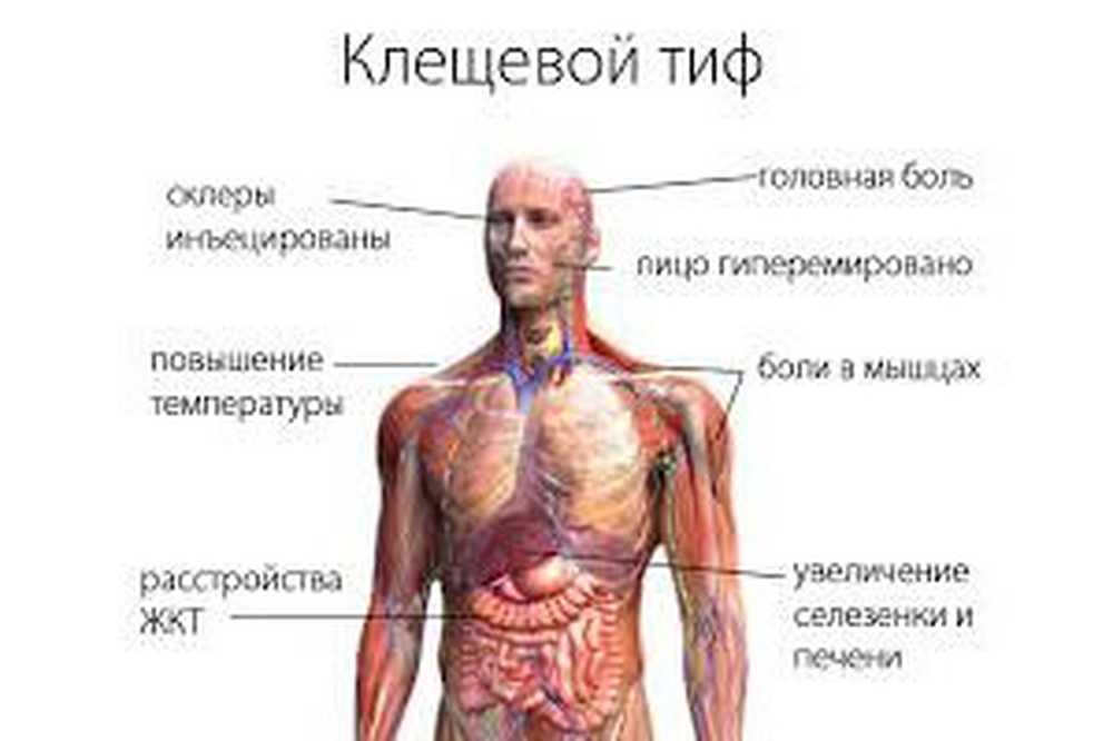 Клещевой возвратный тиф. Клещевой сыпной тиф клиника. Клещевой возвратный тиф клиника. Клещевой сыпной тиф клинические признаки.