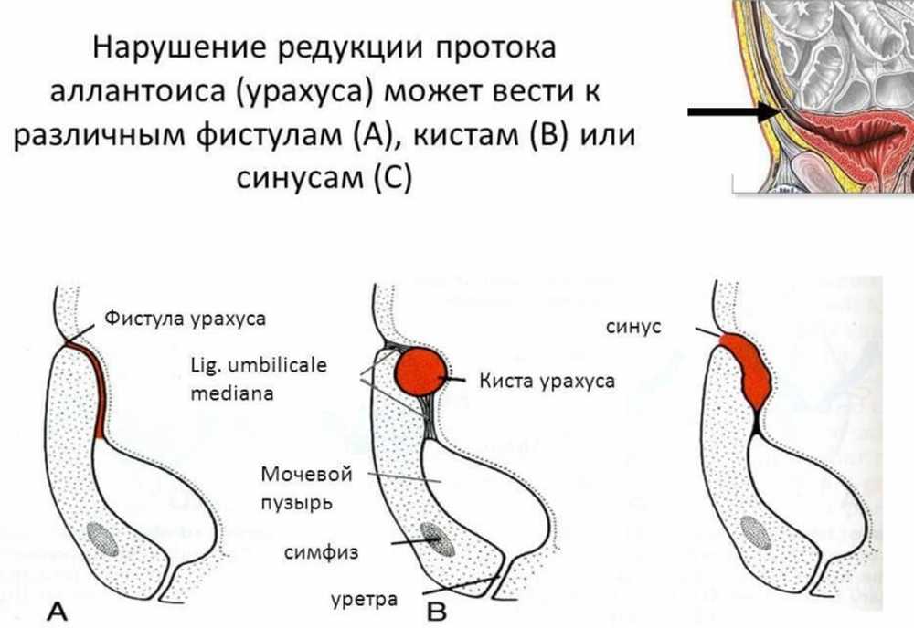 аномалии урахуса и желточного протока. урахус это. урахус это. урахус пупка воспаление. урахус это.