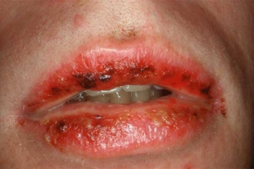 Inflamación del labio
