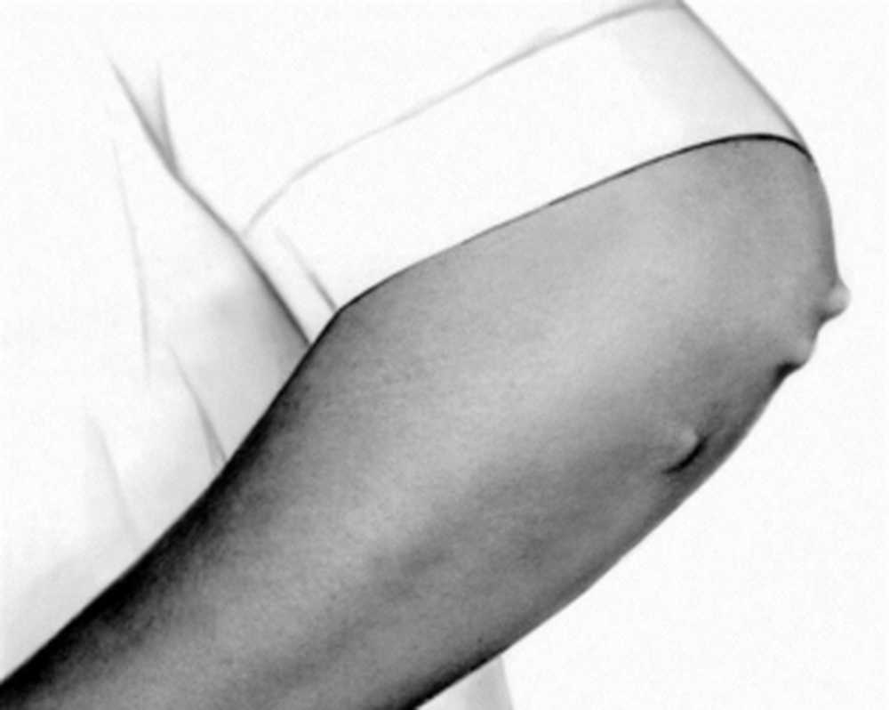 ревматизм локтевых суставов. тейпирование медиального эпикондилита локтевого сустава. ревматизм локтевых суставов. ревматизм локтевых суставов. артрит локтевого сустава рентген.