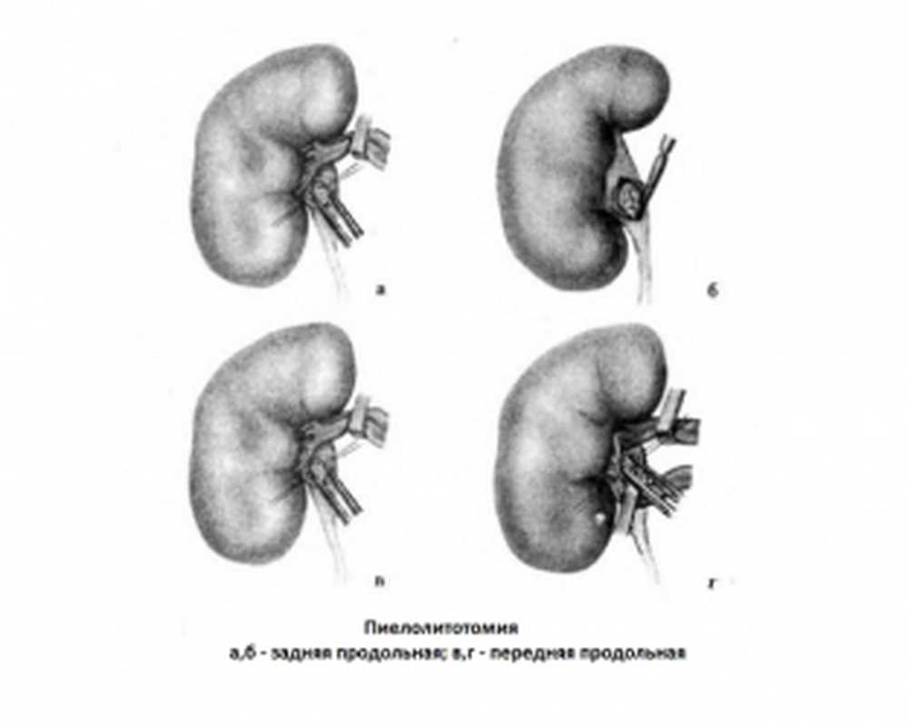 Резекция почки что это. Гидрокаликоз почек патанатомия. Двусторонний гидрокаликоз почек. Резекция почки лапа.
