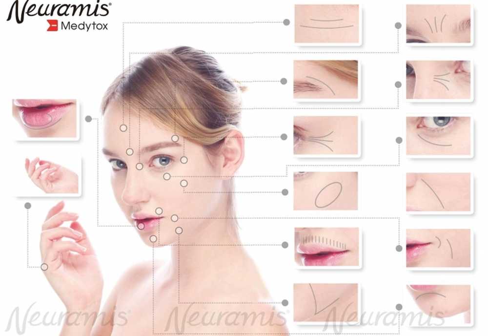 Филлеры схема. Нирамис волюм. Линии для филлеров. Нейрамис для носогубок. Разметка на лице для волюмы.