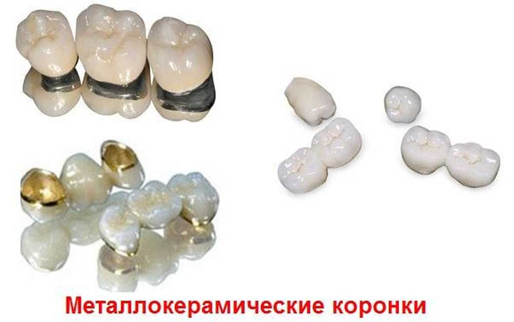 Коронка На Зуб Металлокерамика Цена В Москве