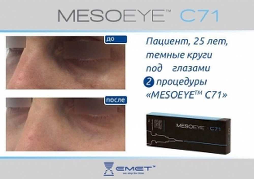 Мезоай цена. MESOEYE препарат. МЕЗОАЙ эффект. MESOEYE c71™. MESOEYE с71.