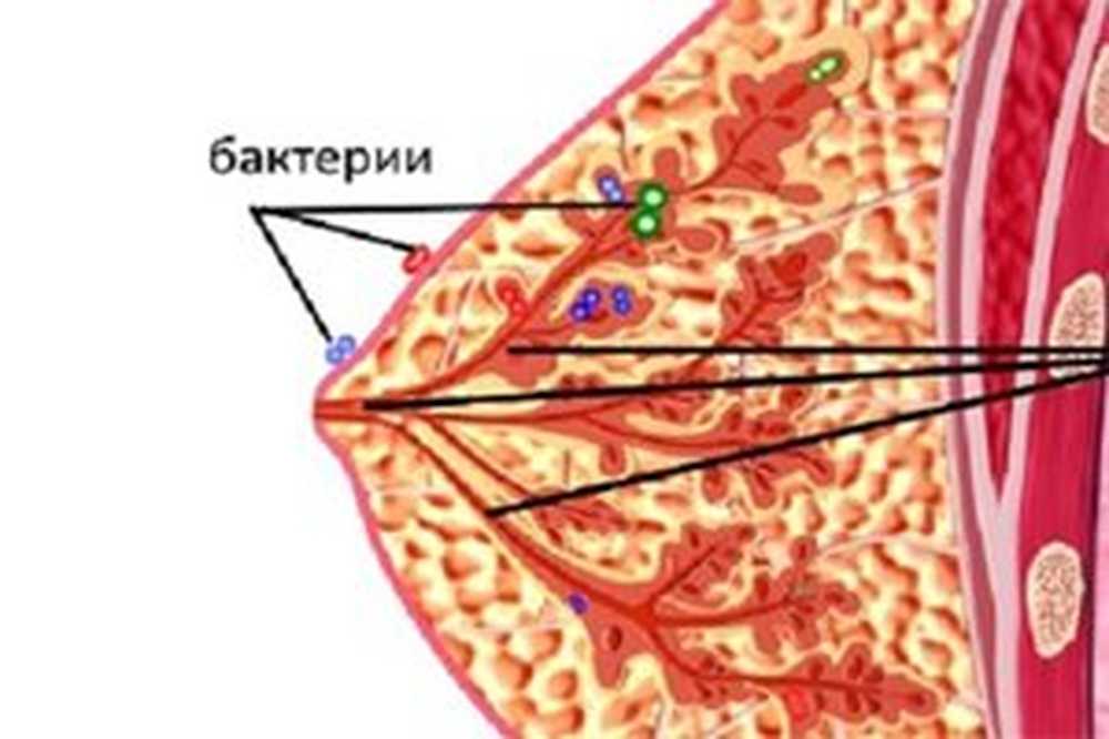 Мастит в домашних условиях быстро и эффективно. Гнойный послеродовый мастит. Острый послеродовой мастит. Нелактационный мастит. Острый инфильтративный мастит.