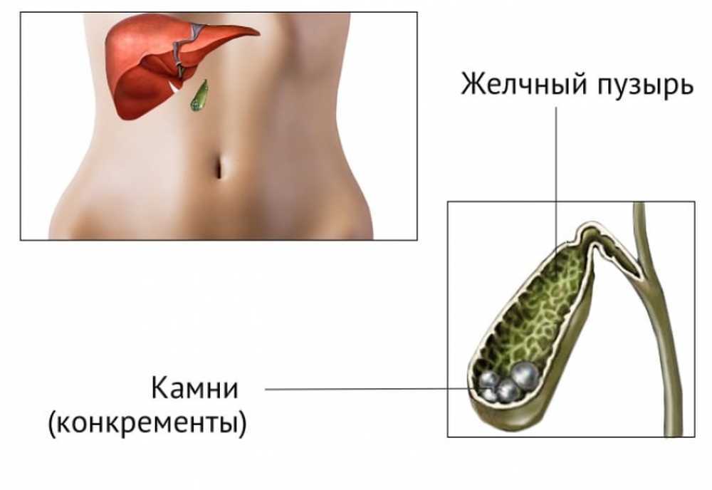 Отекает желчный пузырь