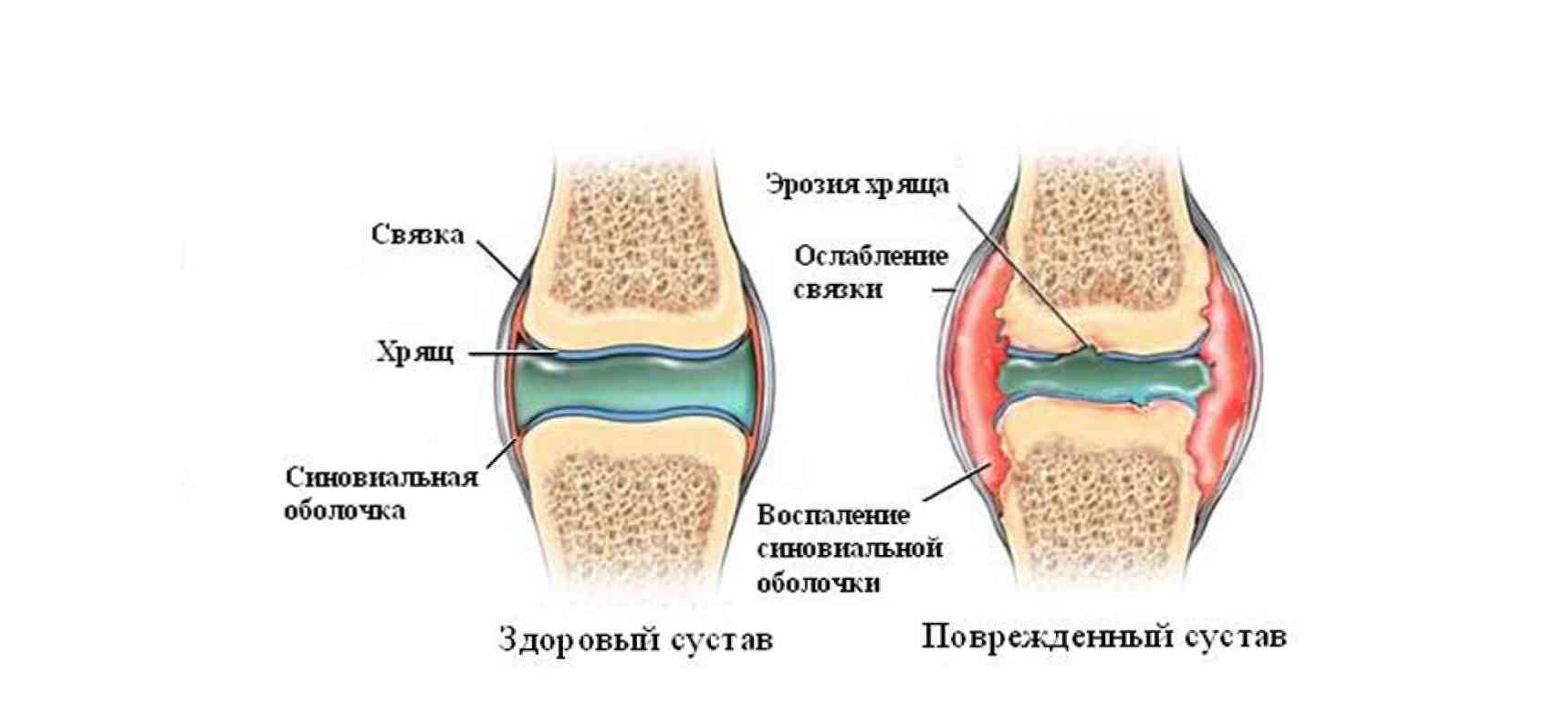 Где находится мениск схема колена