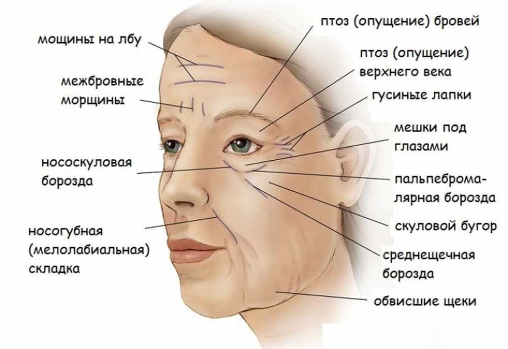 Лоб опускается. Височные морщины. Гравитационные морщины. Схема морщин на лице. Название морщин на лице схема.