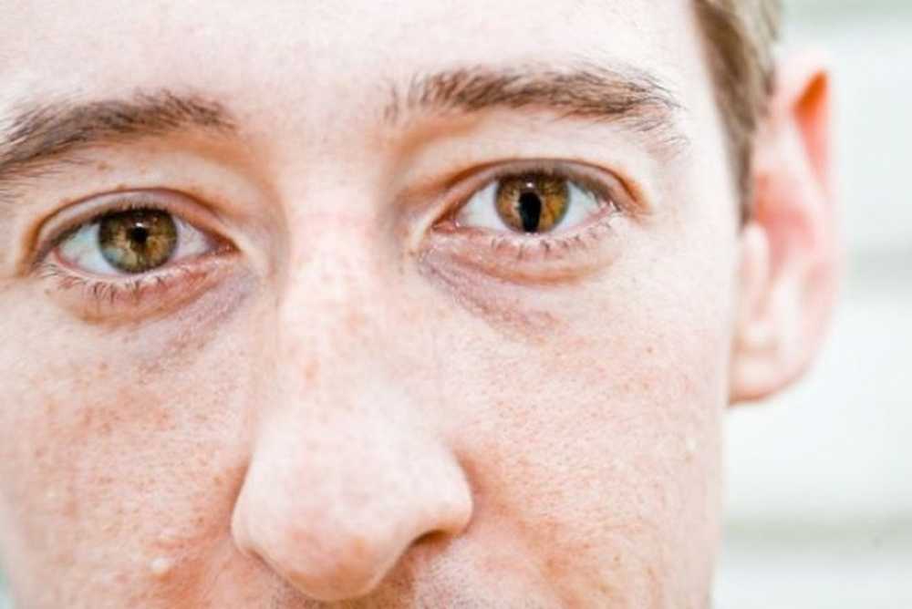 Почему у людей есть глаза. Колобома радужной оболочки глаза. Колобома зрачка у человека. Колобома зрачка зрение.