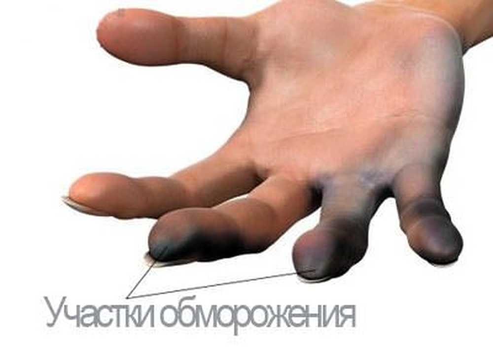 Как выглядит отморожение ног