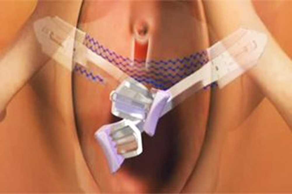 Стрессовое недержание мочи. Препараты при недержании мочи. Недержание мочи после операции. При недержании мочи у женщин препараты. При недержании мочи у мужчин.