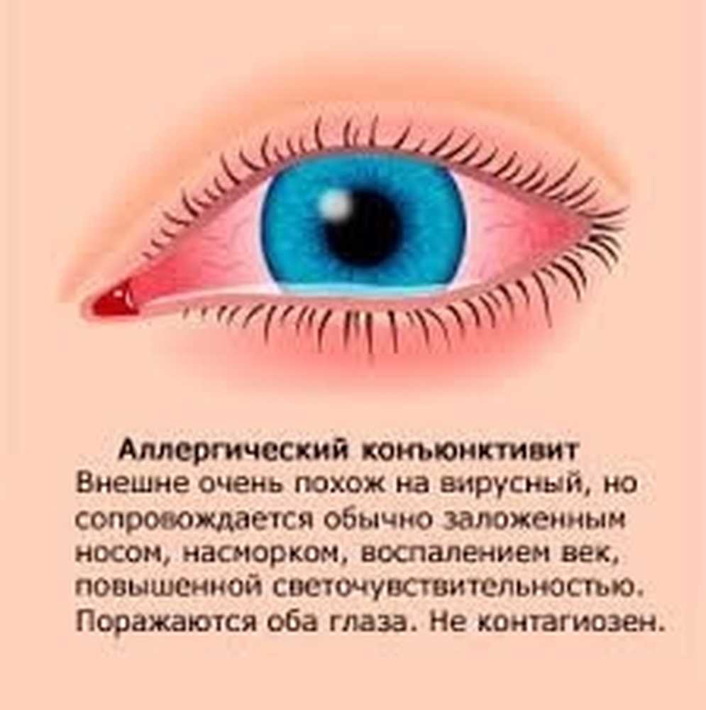 От коньюктивита 3 года. Вирусный конъюнктивит возбудитель. Конъюнктивит бактериальный вирусный аллергический. Конъюнктивит покраснение глаз. Глазная болезнь конъюнктивит.
