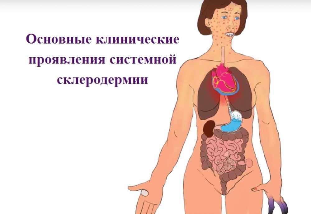Системная склеродермия клинические рекомендации. Склеродермия кожные проявления. Склеродермия на внутренних органах. Поражения внутренних органов при склеродермии.