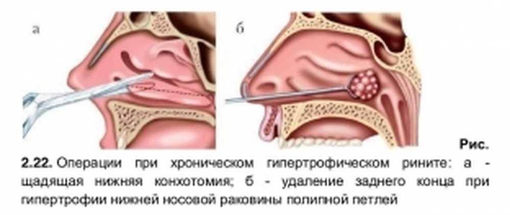 Острый катаральный ринит